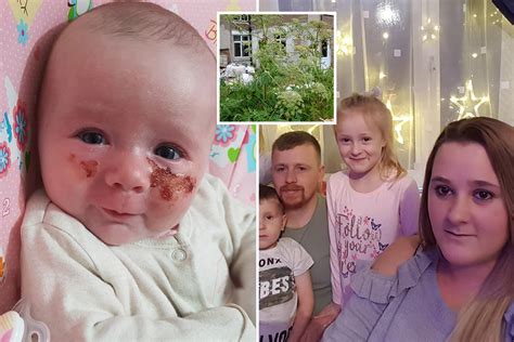 Giant Hogweed Warning After Three Month Old Baby Left With Raw Burns