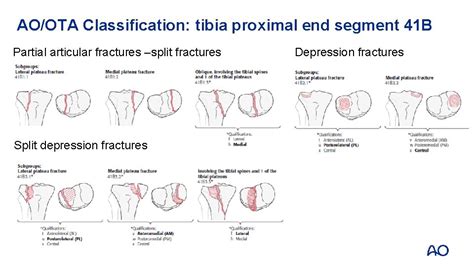 Complex Tibial Plateau Fractures Ao Trauma Advanced Principles