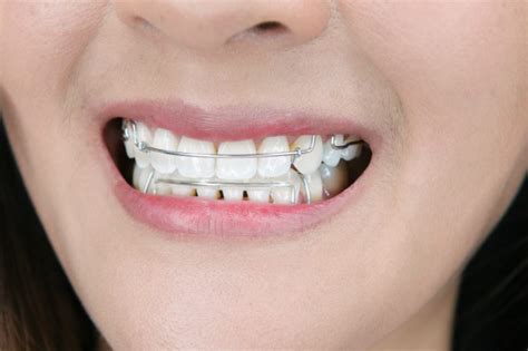 Dental Braces 101 Part 6 Wearing Retainers Archwired