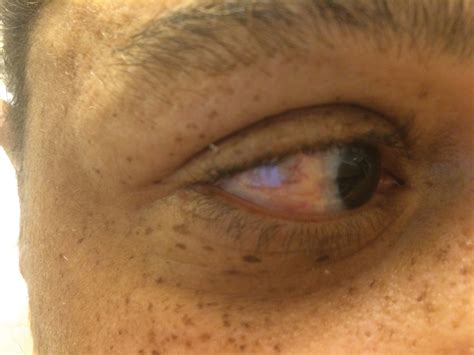 Scleral Plaques In Nephrogenic Systemic Fibrosis Mdedge Dermatology