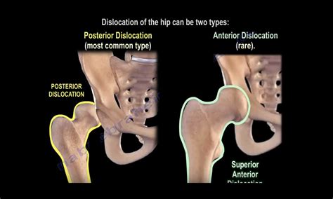 Hip Dislocations And Its Implications —