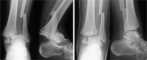 Orif Right Ankle Fracture Icd 10