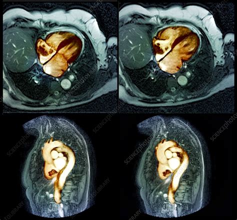 Lung Cancer Mri Stock Image C0239726 Science Photo Library