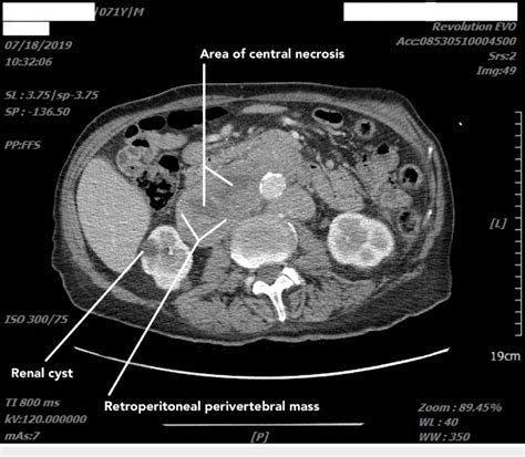 Abdominopelvic Ct Scan With Contrast Shows A Retroperitoneal