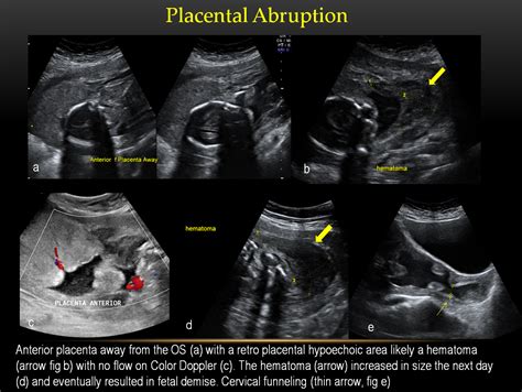 Placental Abruption Ultrasound