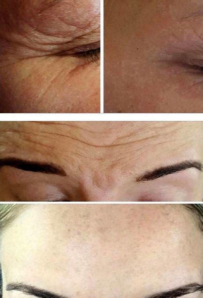 Botox Before And After Forehead 3 Facelift Info Prices Photos