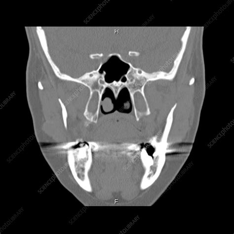 Foramen Rotundum Xray