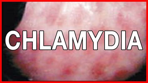 Chlamydia In Women And Men Symptoms Signs And Remedies Youtube