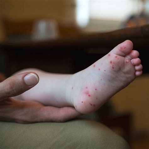 Hand Foot And Mouth Disease Diagnoses Increase In Midstate Doc
