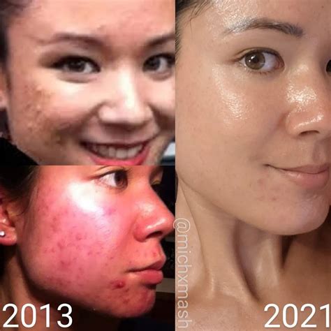 Top 18 Co2 Laser For Acne Scars Before And After 2022