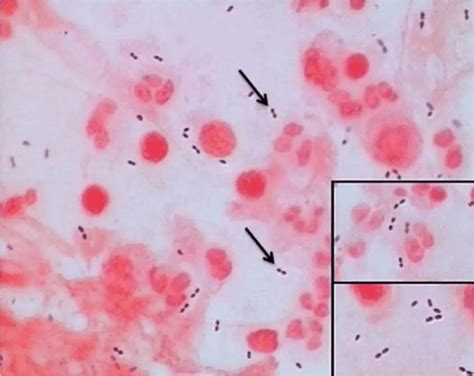 Sputum Sample Collection Transport Staining And Culture Microbe