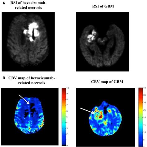 Ab Rsi And Cbv Maps In Bevacizumab Related Necrosis Versus Gbm A