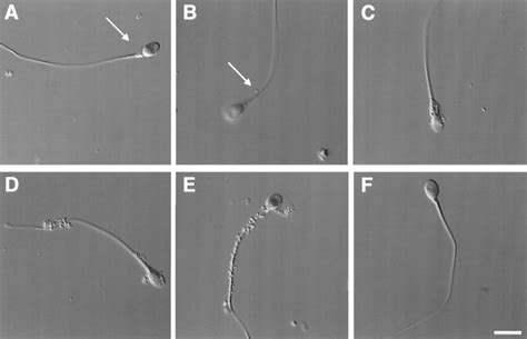 Mycoplasma Genitalium The Prevalent Highly Drug Resistant New Sti