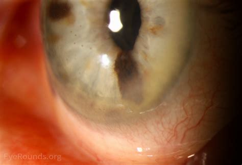 Atlas Entry Iris Melanoma