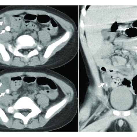 The Ct Scan Of Abdomen Showing A Dilated Appendix With An Appendicolith