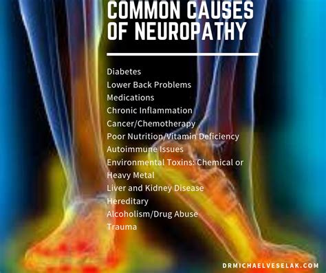 Idiopathic Neuropathy Results In About 30 Of Diagnosed Neuropathy