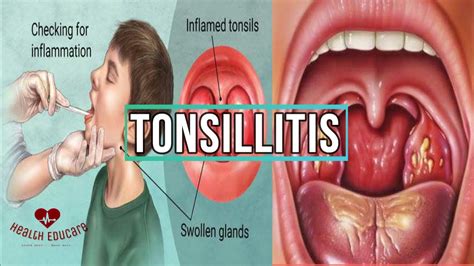 Tonsillitis Treatment