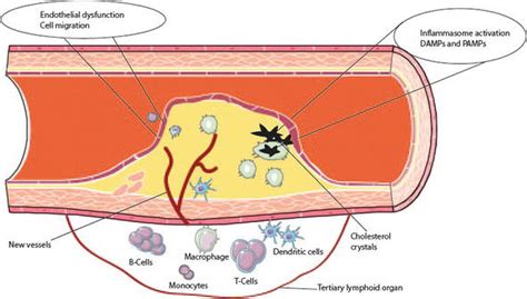 Inflammatory Mechanisms In Atherosclerosis Intechopen