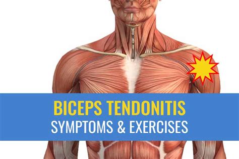 Biceps Tendonitis Treatment Causes Symptoms Exercises And Recovery