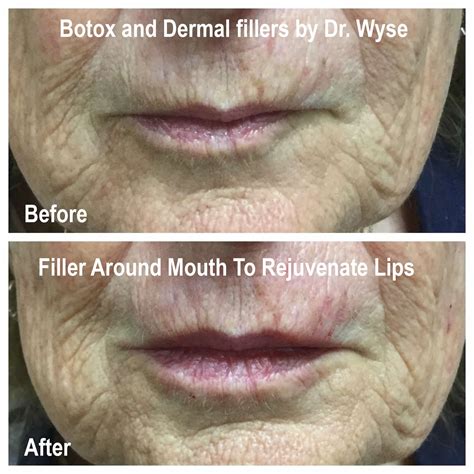 Botox® And Filler Pictures Botox Northbrook Wyse Eyecare
