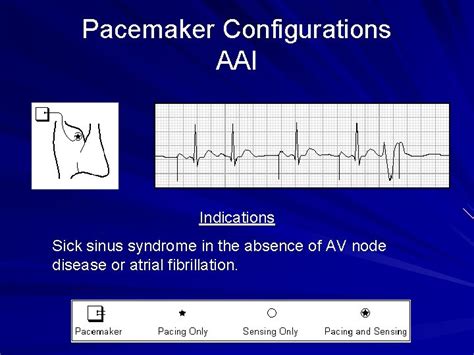 Pacemakers Outline 1 Pacemaker Codes 2 Pacemaker Configurations