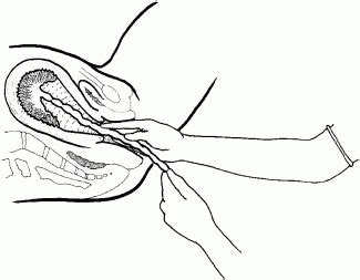 It shows how to perform the procedure… MCPC - Manual removal of placenta - Health Education To ...