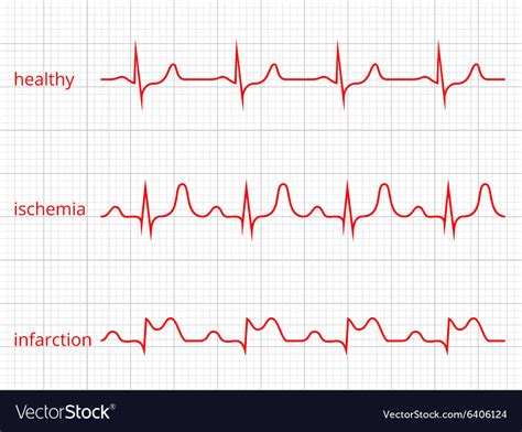 Heart Cardiogram Charts Set Healthy Heart Vector Image