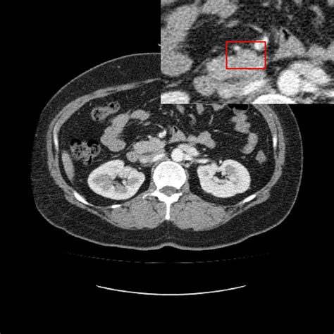 Initial Diagnostic Abdominal Ct Scan No Abnormal Findings Of Superior