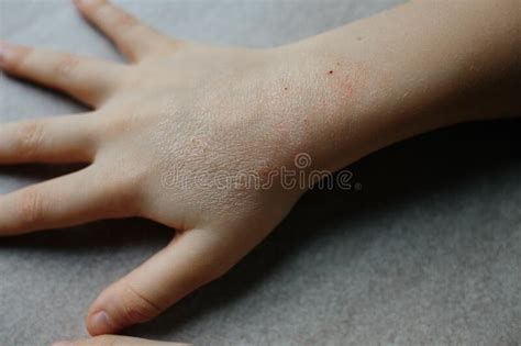 Children Hand With Atopic Dermatitis Eczema On Hand Psoriasis On Kids
