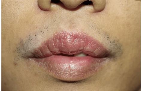 At 5 Months Of Follow Up The Improvement Of The Right Upper Lip