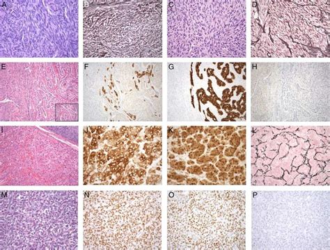 Sex Cord Stromal Tumors Of The Ovary A And B Cellular Fibroma And C