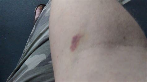 Bruising From Blood Draw Pregnancy Informations