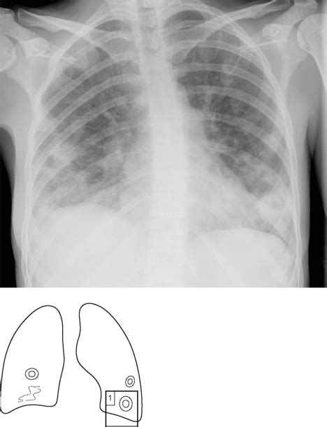 Lung Abscess Radiology Key