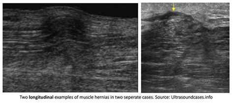 Muscle Herniation Explanation And Ultrasound Assessment Sonoskills