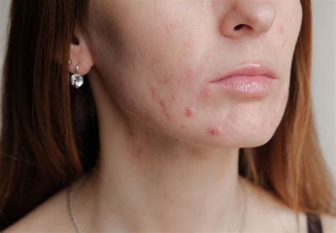 Dermaquip Does Stress Cause Acne Proven Investigates