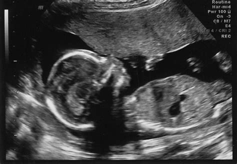 Nyquist 16 Week Ultrasound Its A Boy