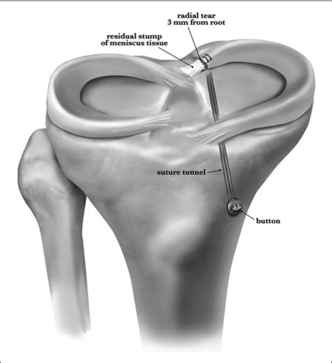 Illustration Of Transtibial Repair Of A Posterior Horn Medial Meniscal