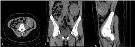 Ct Of The Abdomen Without Contrast In A Axial Scans B Coronal And