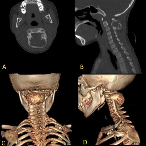 Non Contrast Ct Axial A And Sagittal B Bone Window Showing A
