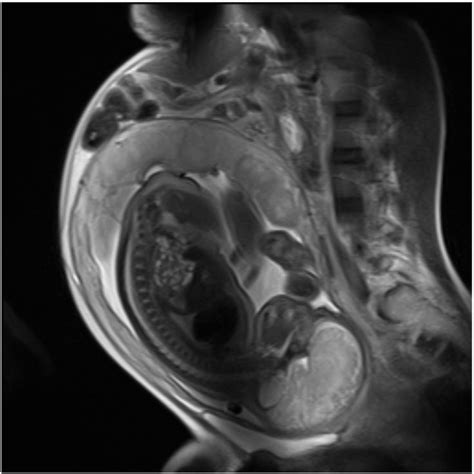 Wow Pregnant Mri Radiology X Ray Mri Scan