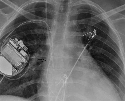 Migration Of Peripherally Inserted Central Catheter Likely