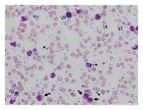 Peripheral Blood Smear Wrightgiemsa Stain 50x Magnification Showing