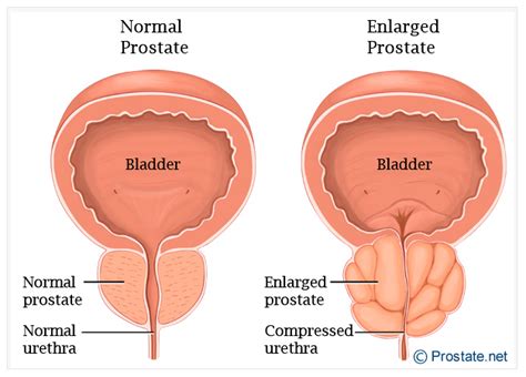 Adenomul De Prostata Cauze Simptome Tratament