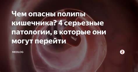 Полипоз кишечника диета Полипы в кишечнике: симптомы и лечение, удаление полипов в кишечнике Полипы в кишечнике: симптомы и лечение, удаление полипов в кишечнике Полипоз кишечника диета