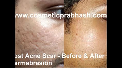 Scar Removal India Scar Revision Before After Delhi Dr Prabhash Youtube