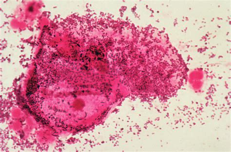 Bacterial Vaginosis Photograph By Dr Y Boussougancnriscience Photo