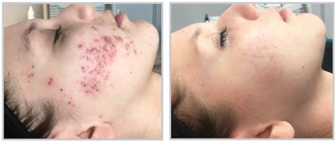 Forever Clear Bbl Acne Treatment In The Woodlands East Shore Salon