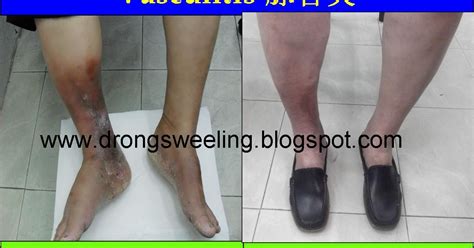 Tcm News Tcm Clinic Physician Treat Vasculitis On Lower Legs