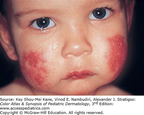 Cutaneous Viral Infections Diagnosis Accessmedicine Network