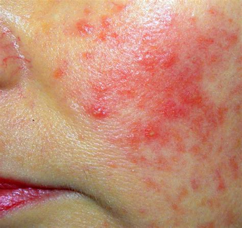 Natural Acne Rosacea Remedies Daves Healing Notes